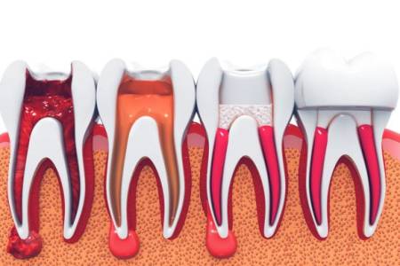 Root Canal Treatment (RCT)