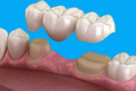 Fixed Ceramic Treatments