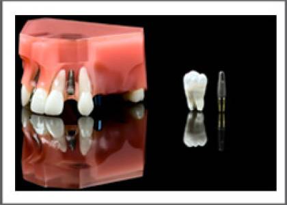 Implant Dentistry