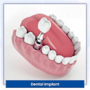 DENTAL IMPLANTS