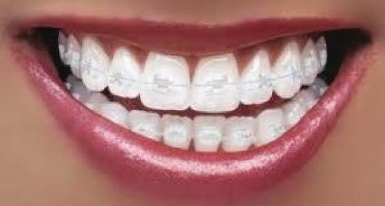 Teeth Whitening