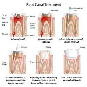 Root Canal Treatment (RCT)