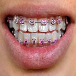 Braces