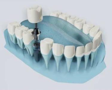 Implant Supported Dentures