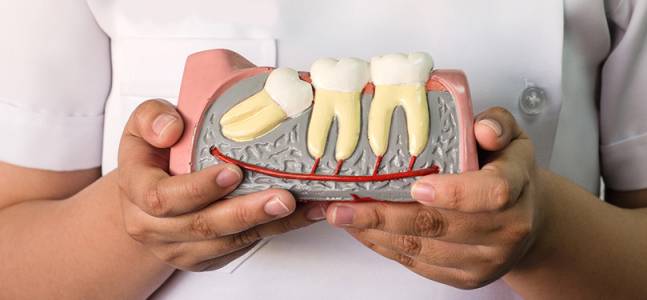 Wisdom Teeth Removal