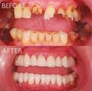 Full Mouth Rehabilitation