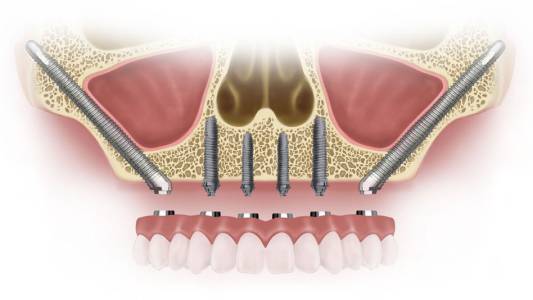 Advanced Dental Implant