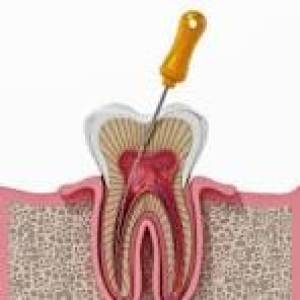 ROOT CANAL