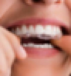 dental aligners