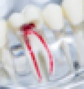 root canal