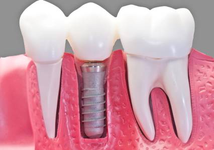 Dental Implants