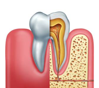 Root Canal Treatment (RCT)