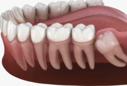 Root Canal Treatment (RCT)