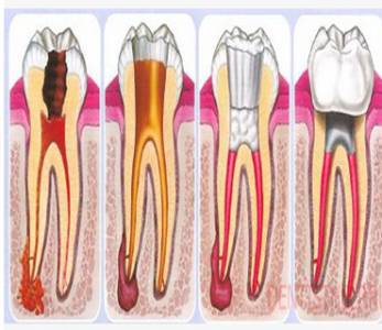 Root Canal Treatments