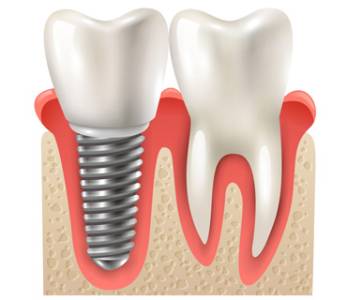 Dental Implants