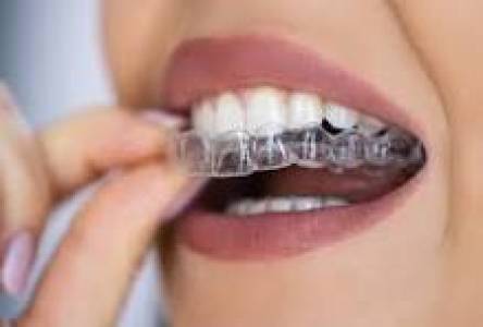 ALIGNERS