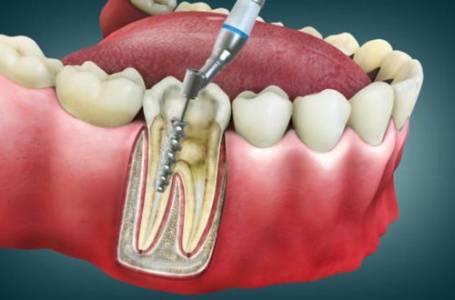 Root Canal Treatment