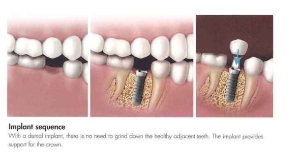 Dental Implants in Vadodara