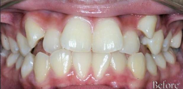 Orthodontic Treatment
