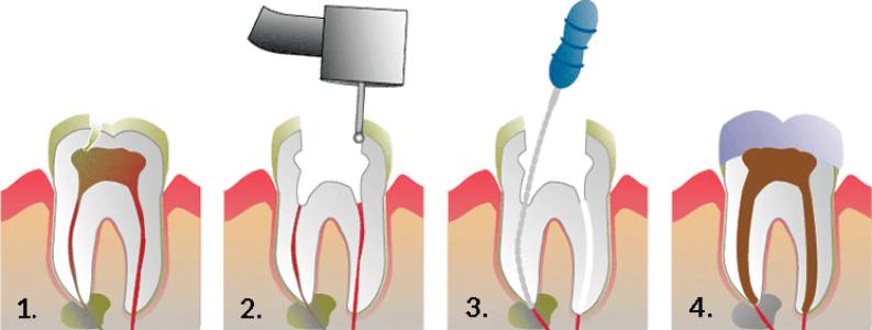 Root Canal Treatment In Vadodara