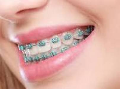 Braces & Aligners