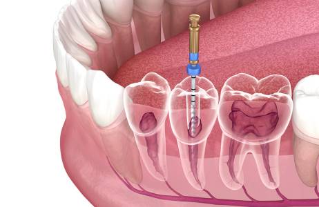 Painless Root Canal Treatment