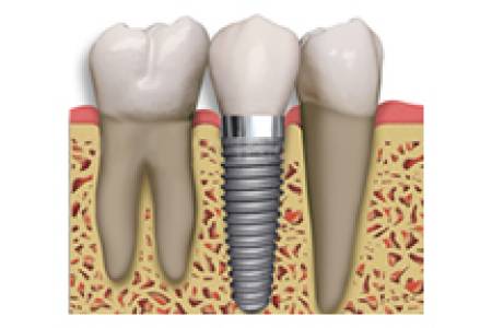 Dental Implants
