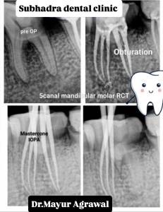 Root Canal Treatment