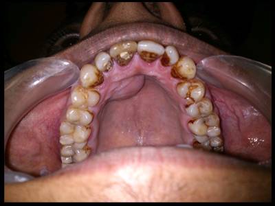 Cysts and tumours of jaws