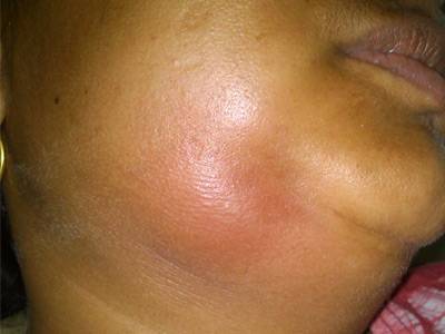 Infections of mouth ,face and neck