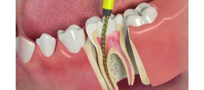 Root Canal Treatment