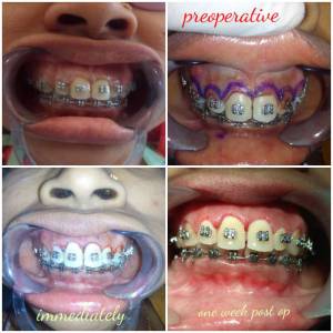Smile Correction