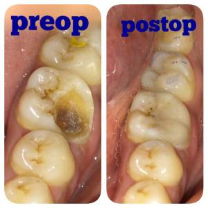 Tooth Coloured Filling