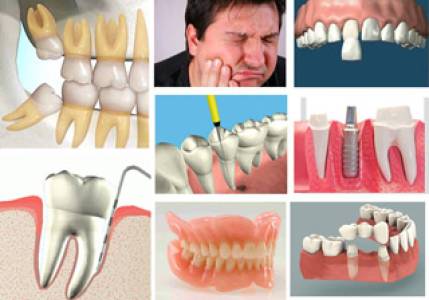 Root Canal Treatment (Endodontics)