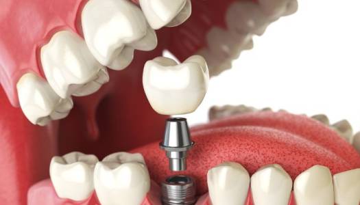 Extractions (Oral Surgery)Crowns