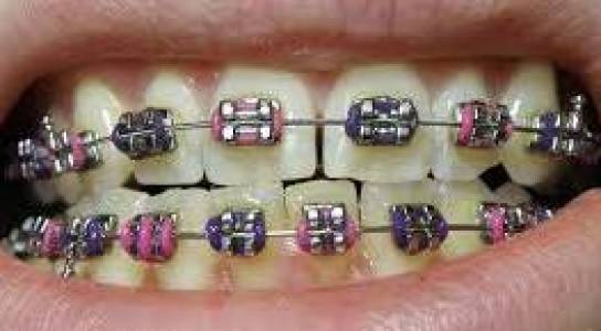 Bridges and Dentures (Prosthodontics)