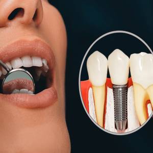 Dental Implants