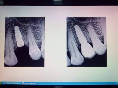 Dental Implants