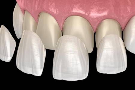 Veneers (Esthetic Smile Design)