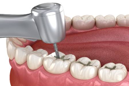 Dental Restoration