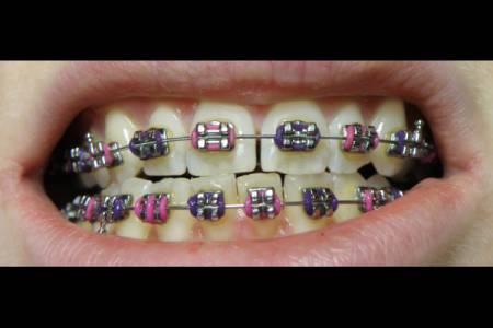 Dental Braces