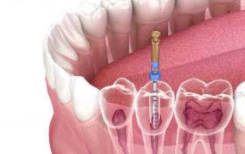 Orthodontic Treatment