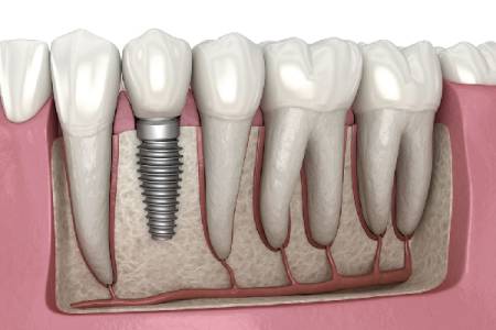 Root Canal Treatment (RCT)