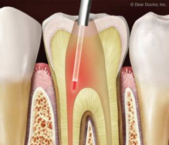 Root Canal Treatment