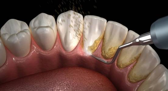 Periodontal Treatment
