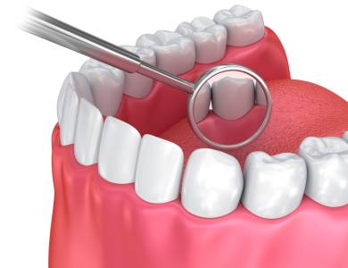 Dental Crowns and Bridges