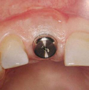 Single Tooth Implant