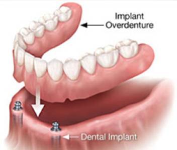 Implant Supported Dentures