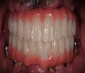Full Mouth Implant