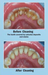 Teeth Cleaning